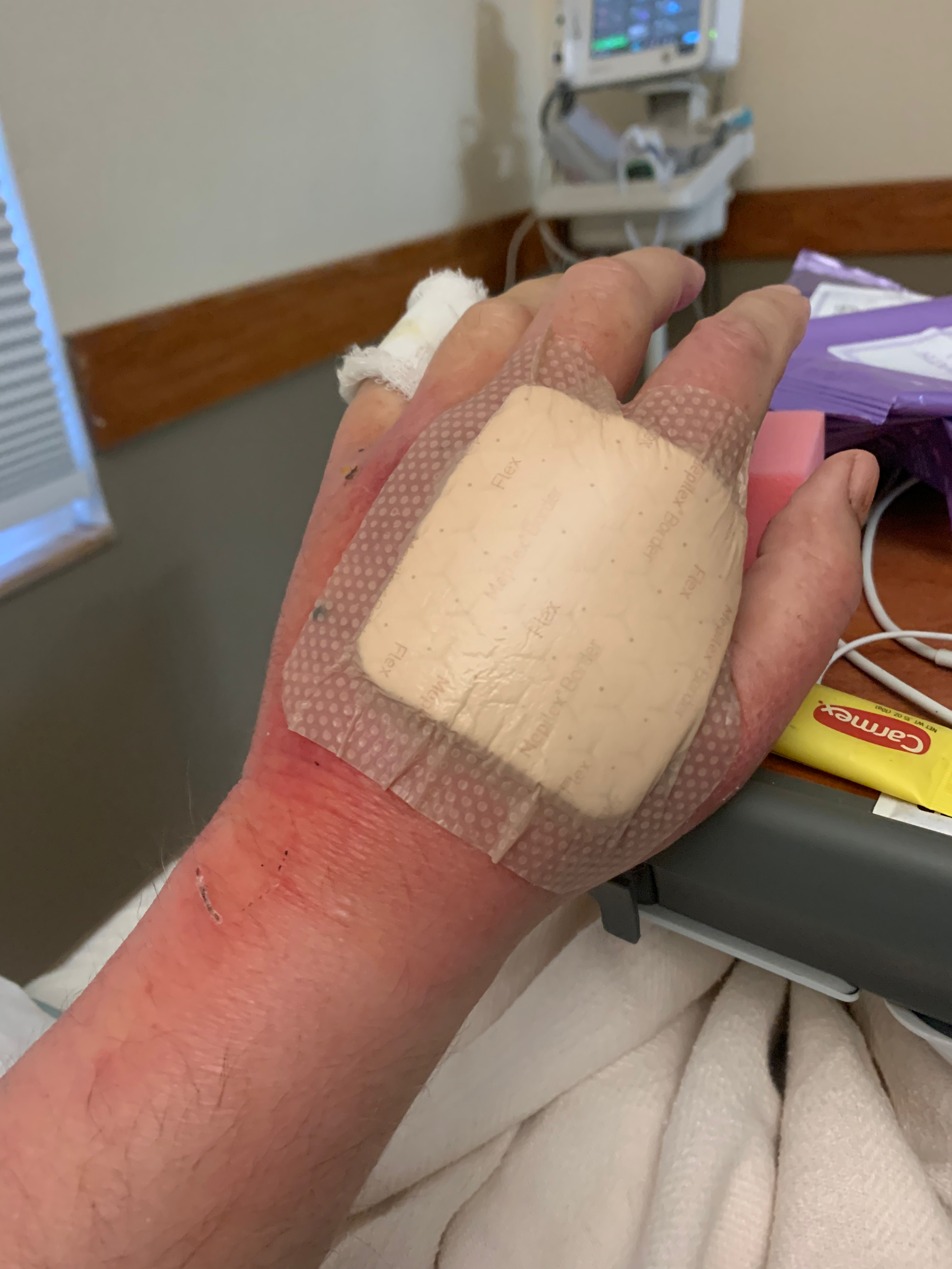 Cellulitis PNG